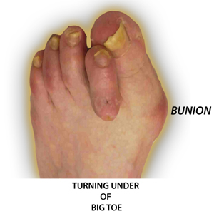 bunion turning under big toe