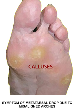 calluses on foot