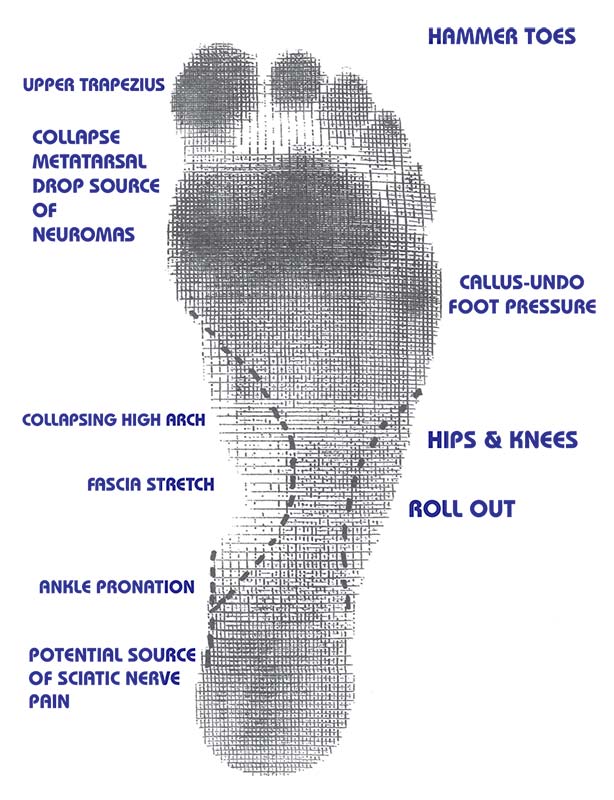 Orthotics for Common Foot Ailments - Pronation & Supination