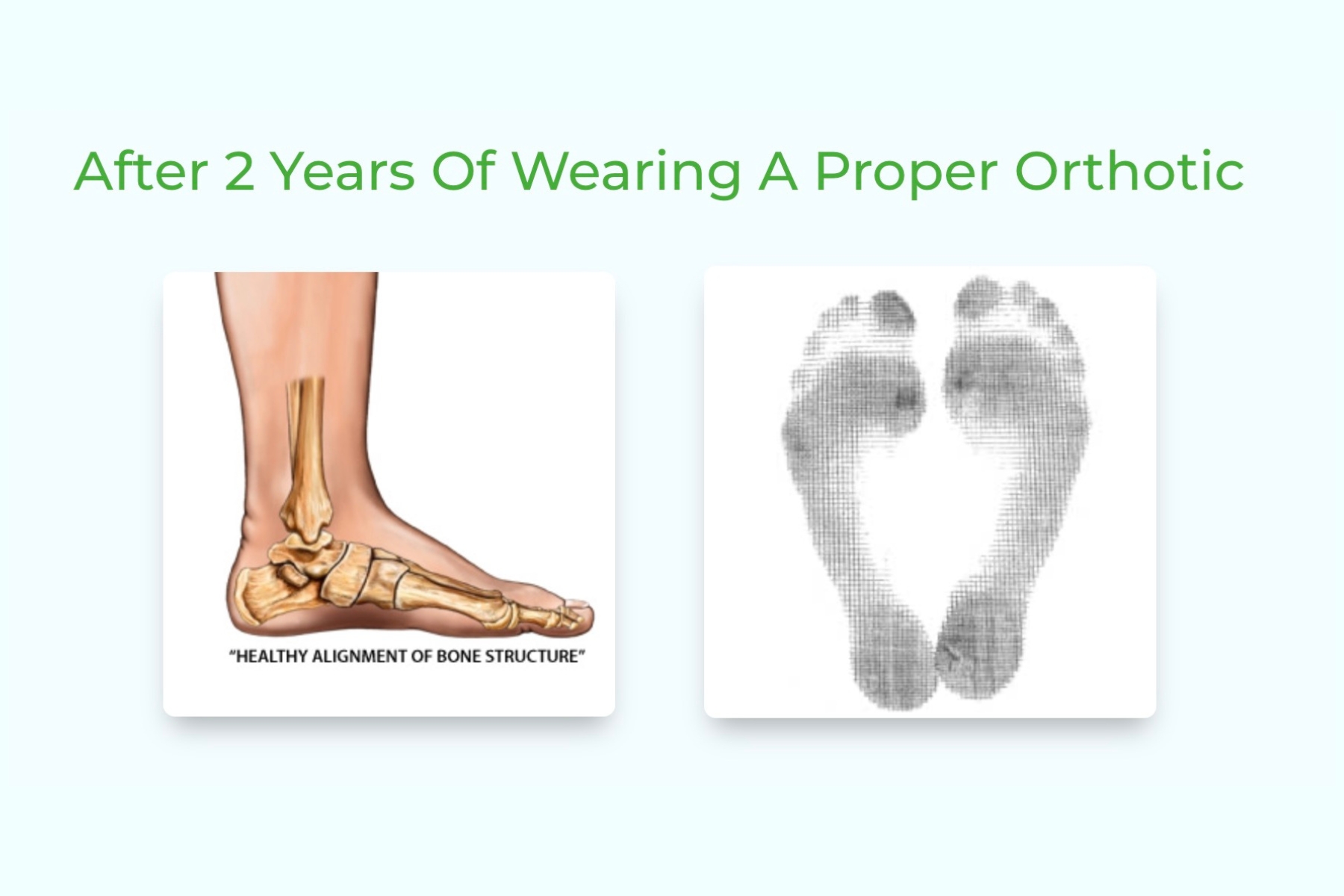 An aligned foot imprint after 2 years of wearing orthotics