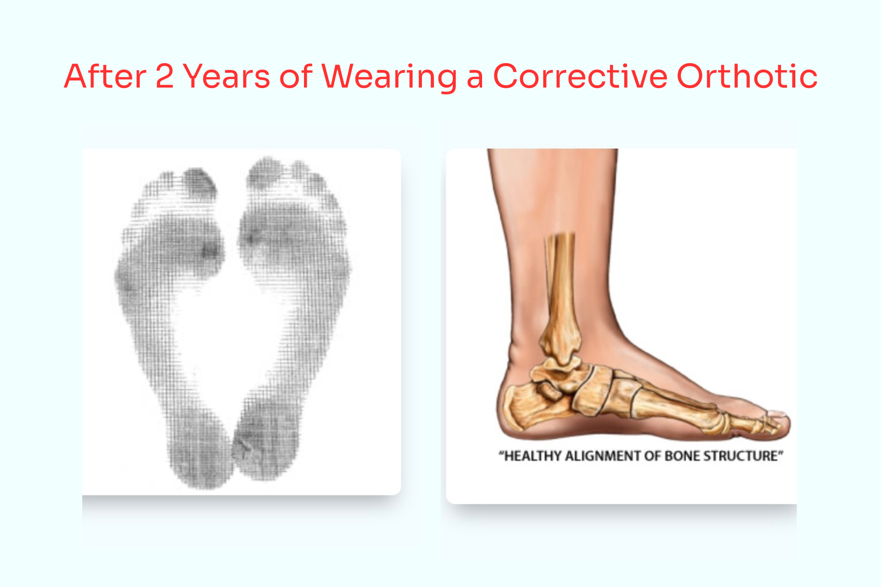 foot after correction