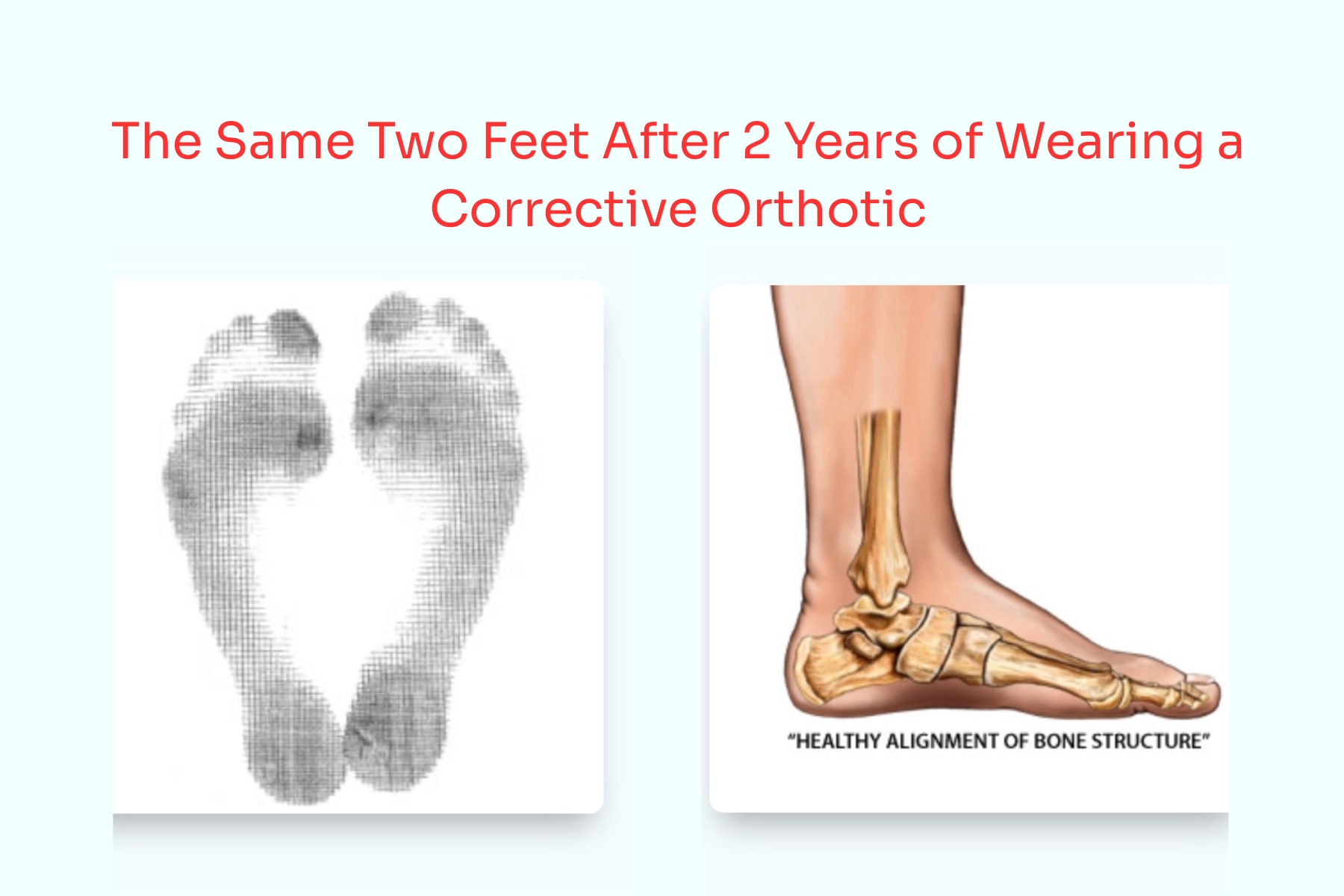 foot after correction